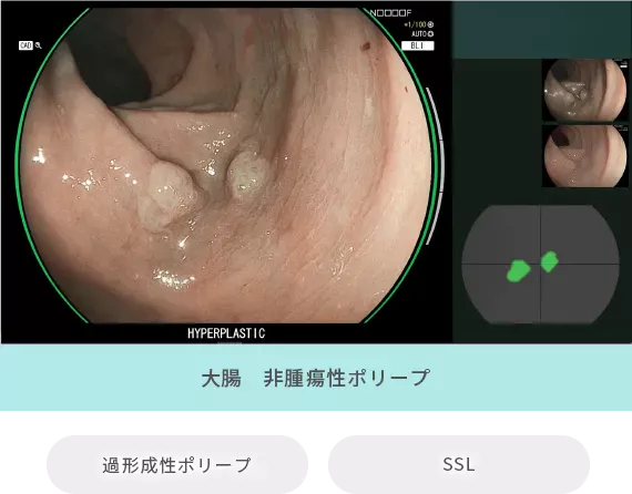大腸：非腫瘍性ポリープ