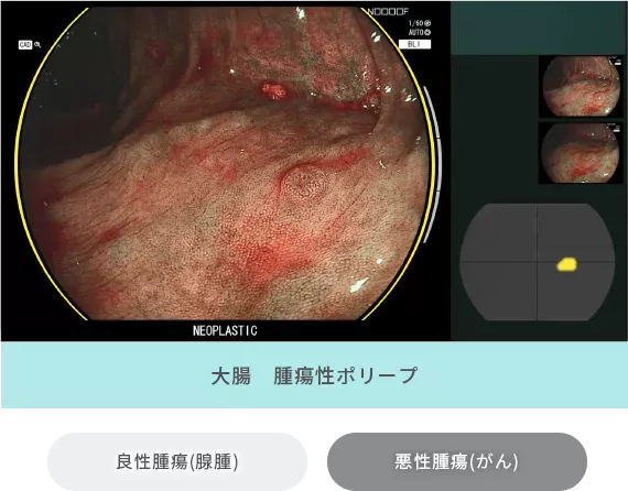 大腸：腫瘍性ポリープ