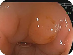 60歳台の男性、検診の二次精密検査での大腸カメラの画像です。画面中央、少し赤くなって盛り上がっている部分があります。
