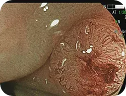 レーザー光による観察に切り替えて、更に拡大します。前の写真に比べて、表面の模様がより際立って見えます。画面左側の正常な粘膜と比べて長細くなっていますがバラバラではなく、良性腫瘍を考えました。