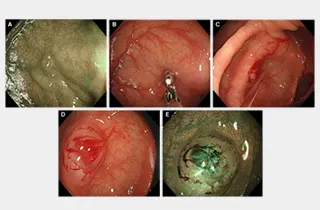 大腸カメラ検査でポリープが見つかった場合、状態によってはそのままポリープを切除できます